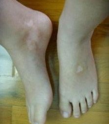 韶关白癜风最好的专科医院