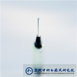 治疗白癜风与血液异常是否有关系