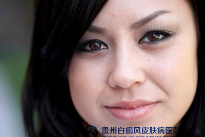 治疗白癜风的注意点 治疗白癜风的注意点