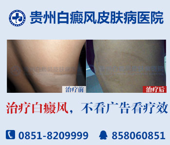 贵州哪里可以做白癜风的手术 贵州哪里可以做白癜风的手术
