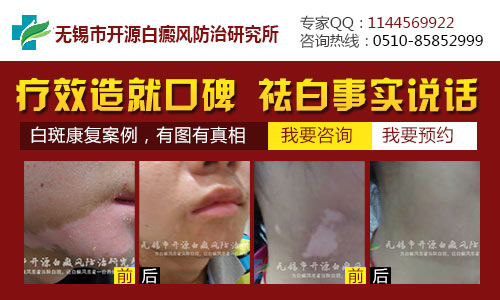 无锡哪里是白癜风专科医院