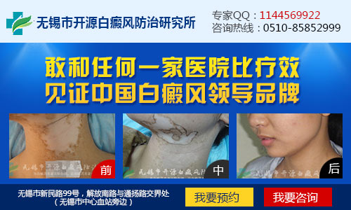 嘉兴白癜风哪里治疗最好 嘉兴白癜风哪里治疗最好
