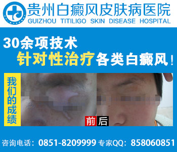 贵阳哪家治疗白癜风好 贵阳哪家治疗白癜风好