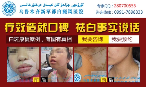 乌鲁木齐白癜风哪家医院疗效好