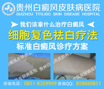 柳州治疗白癜风 柳州治疗白癜风