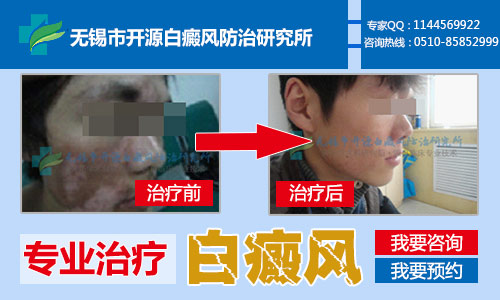 无锡白癜风医院最好的是哪家 无锡白癜风医院最好的是哪家