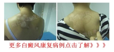烟台白癜风医院 烟台白癜风医院