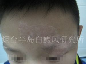儿童头部白癜风 儿童头部白癜风