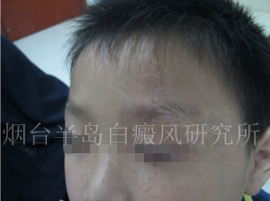 儿童头部白癜风 儿童头部白癜风