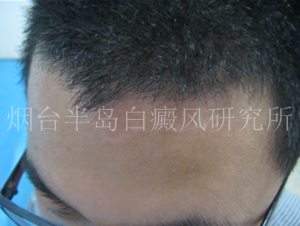 男性头部白癜风 男性头部白癜风