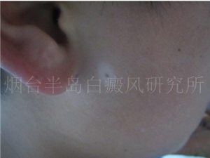 儿童面部晕痣型白癜风2个月 儿童面部晕痣型白癜风2个月