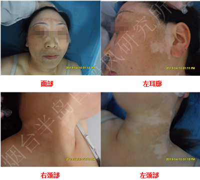 女性面颈部散发型白癜风6个月 女性面颈部散发型白癜风6个月