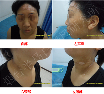 女性面颈部散发型白癜风6个月 女性面颈部散发型白癜风6个月