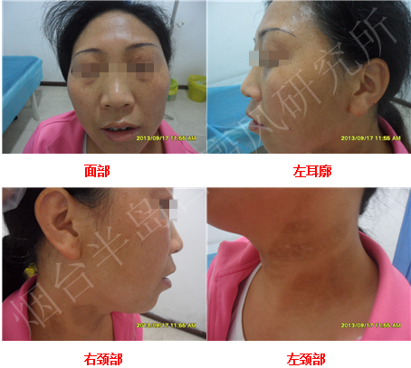 女性面颈部散发型白癜风6个月 女性面颈部散发型白癜风6个月