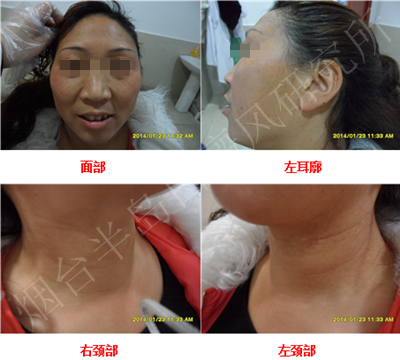 女性面颈部散发型白癜风6个月 女性面颈部散发型白癜风6个月