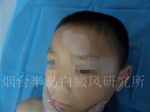 偏方可以治疗白癜风吗 偏方可以治疗白癜风吗