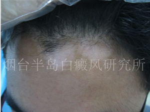 白癜风是怎样形成的 白癜风是怎样形成的
