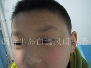 儿童白癜风的发病原因 儿童白癜风的发病原因