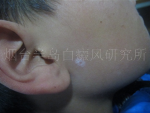烟台白癜风治疗哪家最好 烟台白癜风治疗哪家最好