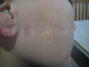 白癜风不容易根治的原因 白癜风不容易根治的原因
