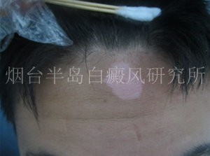 白癜风为什么治不好 白癜风为什么治不好