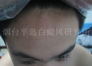 青少年白癜风的危害 青少年白癜风的危害