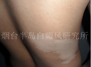 面部白癜风危害有哪些 面部白癜风危害有哪些