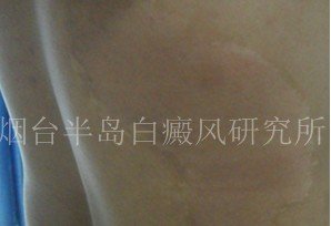 白癜风的危害有哪些 白癜风的危害有哪些